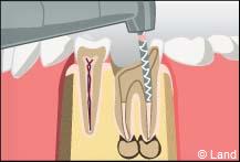 traitement radiculaire
